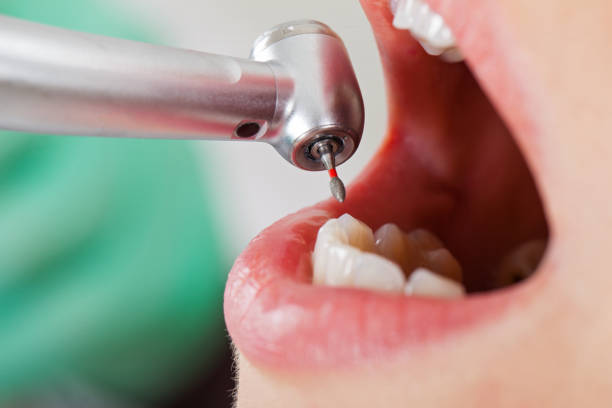 Best Emergency Wisdom Tooth Extraction in Queen Anne, MD